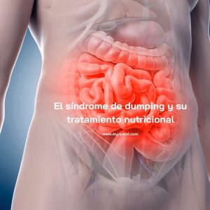 El síndrome de dumping y su tratamiento nutricional, nutricionista, nutricionista clínica