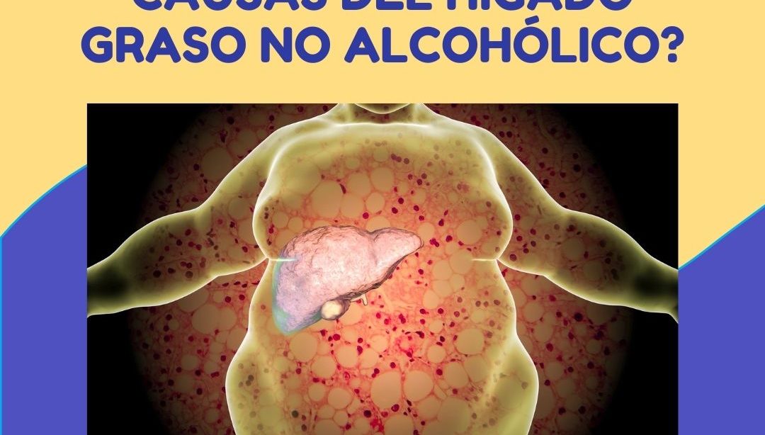 ¿Cuales son las causas del hígado graso no alcohólico?, nutricionista, nutricionista clínica