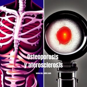 Osteoporosis y aterosclerosis, nutricionista, nutricionista clínica